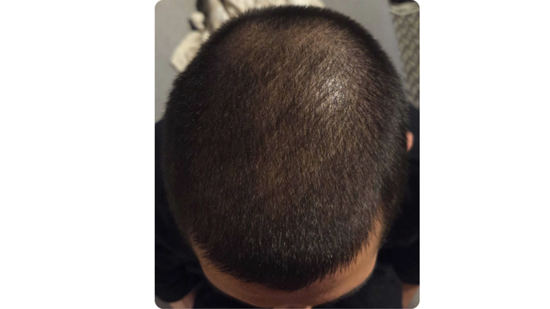 Participant 1 after treatment