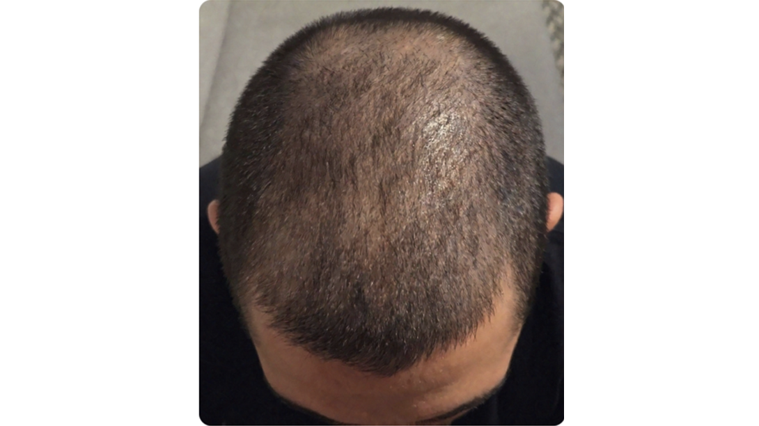 Participant 1 before treatment
