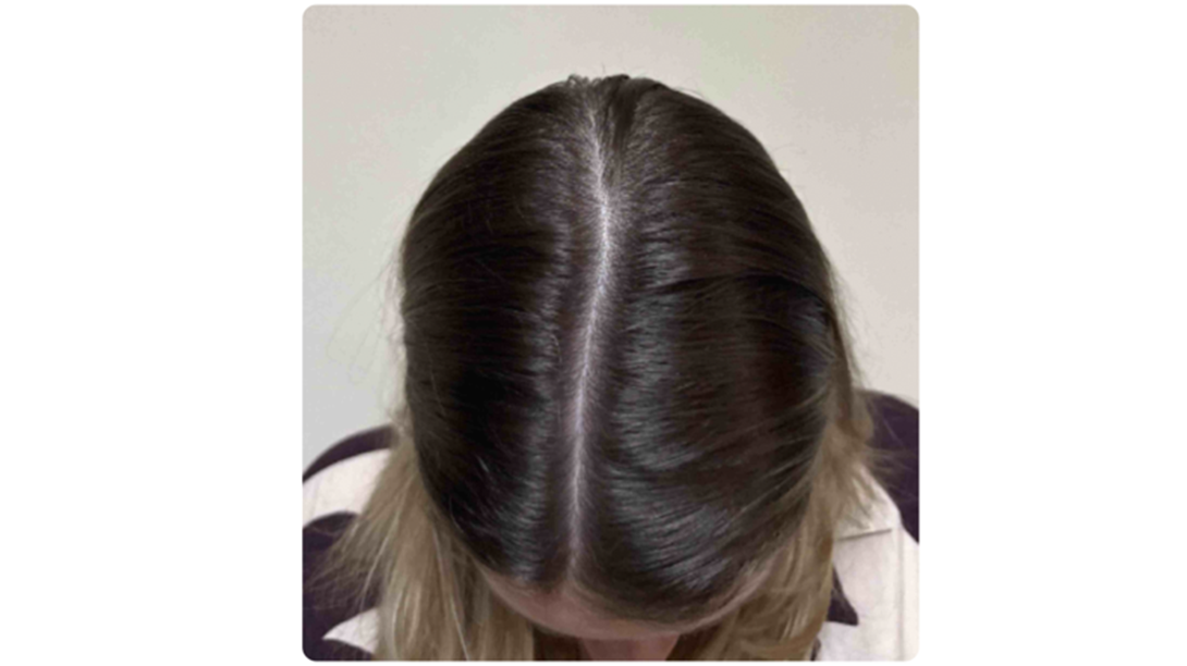 Participant 2 after treatment