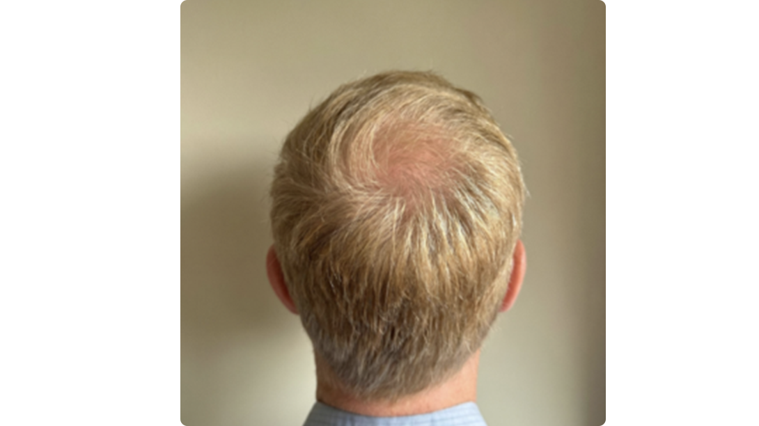 Participant 3 after treatment
