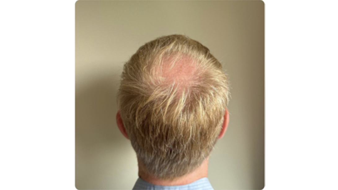 Participant 3 before treatment